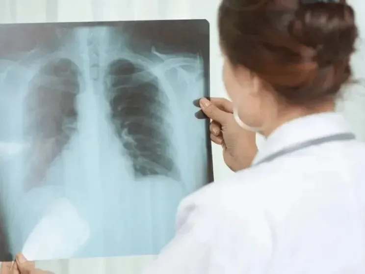 Alerta sanitaria: Los casos de tuberculosis aumentaron casi un 39% en lo que va de 2026